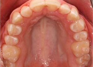 A close-up view of the upper palate and teeth inside a person's mouth, showing healthy gums and well-aligned teeth, as seen at Chestnut Dental Needham.