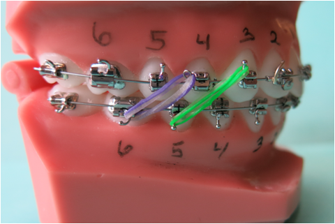 Dental model with braces numbered 2 to 6, showing purple and green orthodontic elastics attached to brackets on the upper and lower teeth at Chestnut Dental Needham.