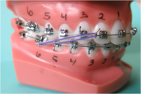 Dental model from Chestnut Dental Needham showing braces with numbered teeth and a purple elastic band connecting upper and lower brackets on the right side. Also available at our Bedford and Franklin locations.