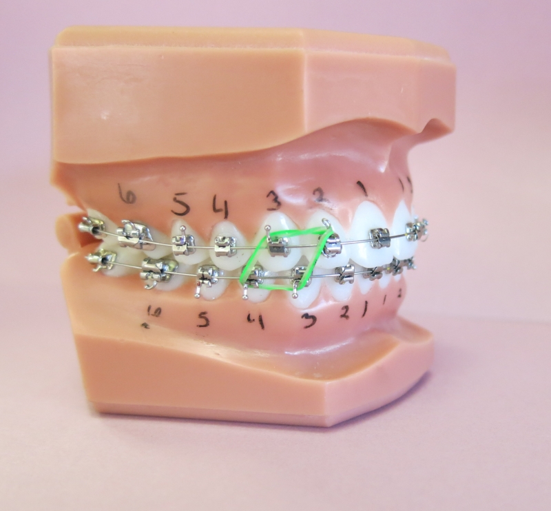 Dental model with braces, numbered teeth, and a green orthodontic elastic band displayed on a pink background at Chestnut Dental Needham.
