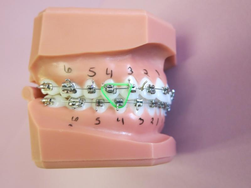 A dental model with braces, numbered teeth, and a green elastic forming a triangle connecting three brackets on the front teeth at Chestnut Dental Needham.