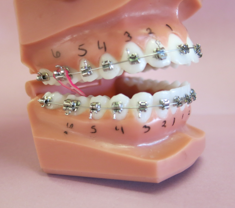 Dental model showing upper and lower teeth with braces, numbered 1 to 6, and a pink elastic band connecting two brackets—an example used at Chestnut Dental Needham.