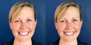 Side-by-side comparison of a woman smiling in front of a blue wall, with her natural skin on the left and smoother, edited skin on the right—capturing confidence similar to smiles seen at Chestnut Dental Needham.