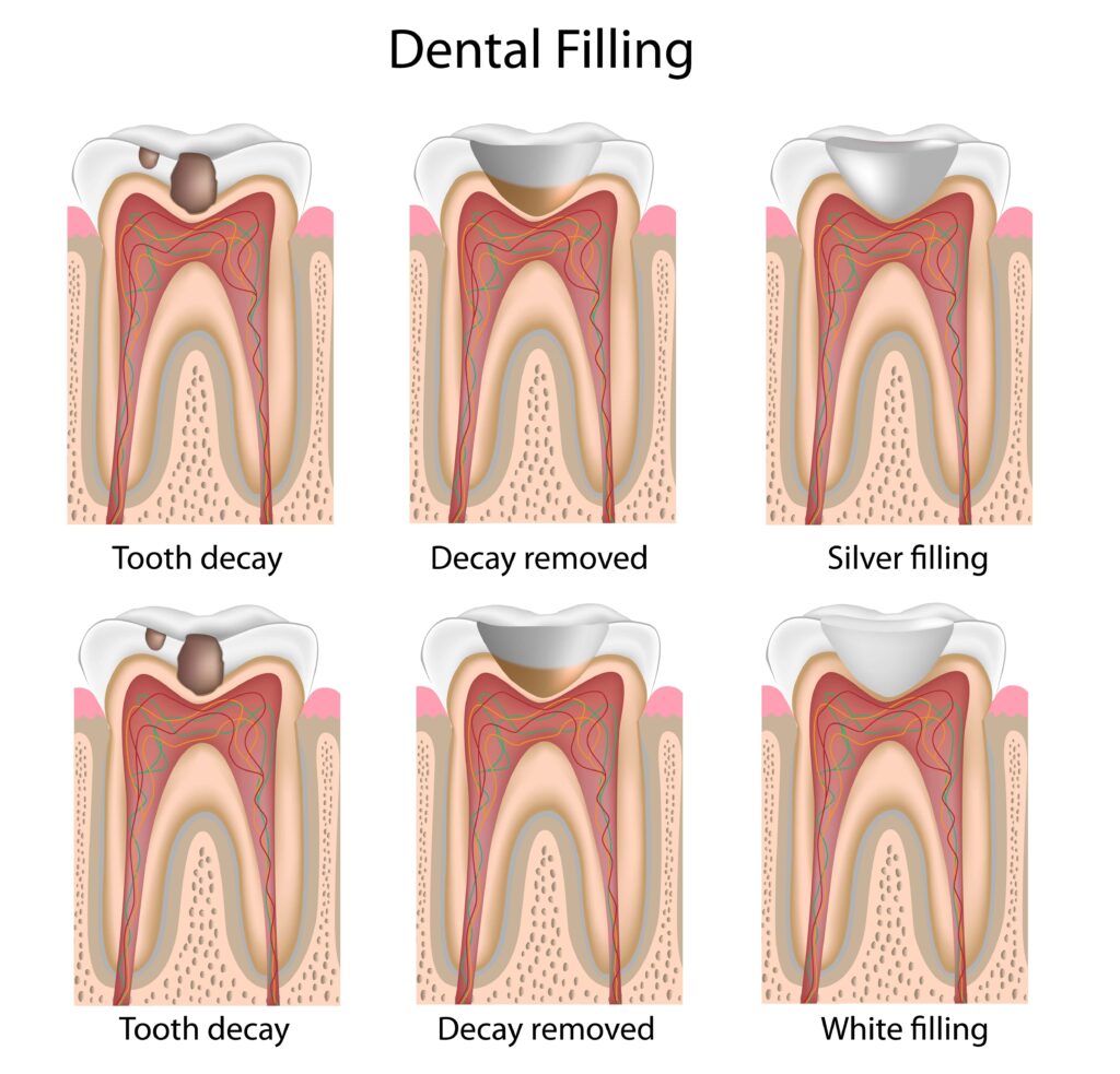 steps of a dental filling from tooth decay, decay removed, to the filling restoring the tooth