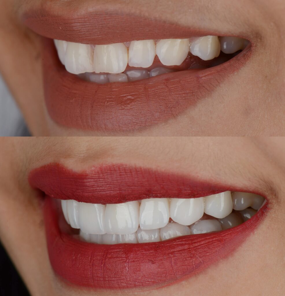 before and after dental veneers