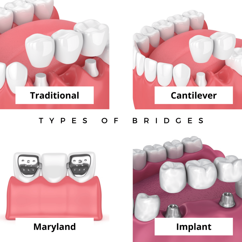 four types of dental bridges: traditional, cantilever, Maryland, and implant-supported